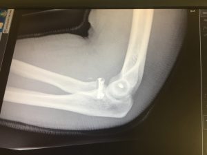 After - with screws and sutures in my elbow